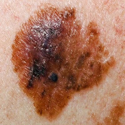 Melanoma Melanoma Treatment at CutisCo Dermatology | Skin Cancer Care