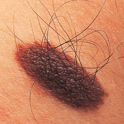 Moles Mole Evaluation at CutisCo Dermatology | Skin Health Check